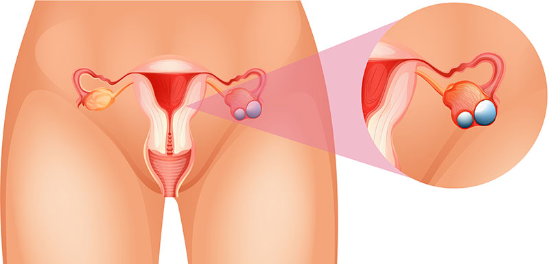 PCOS or Ovarian Cancer? Before you worry, know the difference